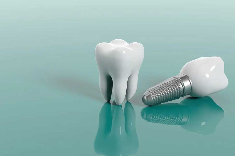 Dental Implants