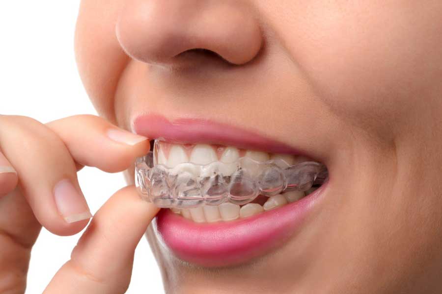 Invisible Braces/Aligners